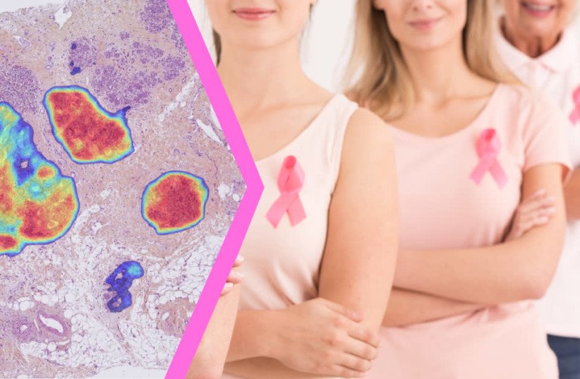 Israeli company uses AI to detect breast cancer