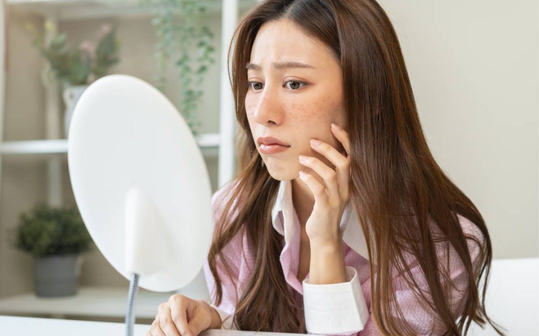 Pregnancy Melasma: Understanding and Managing the ‘Mask of Pregnancy’