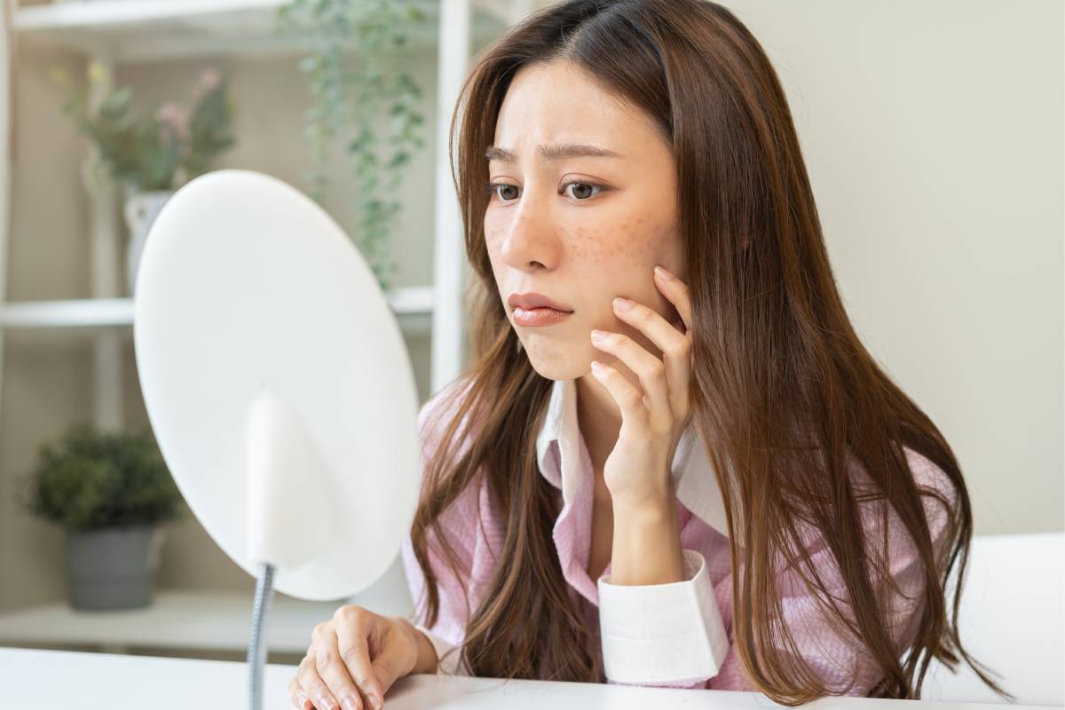 Pregnancy Melasma: Understanding and Managing