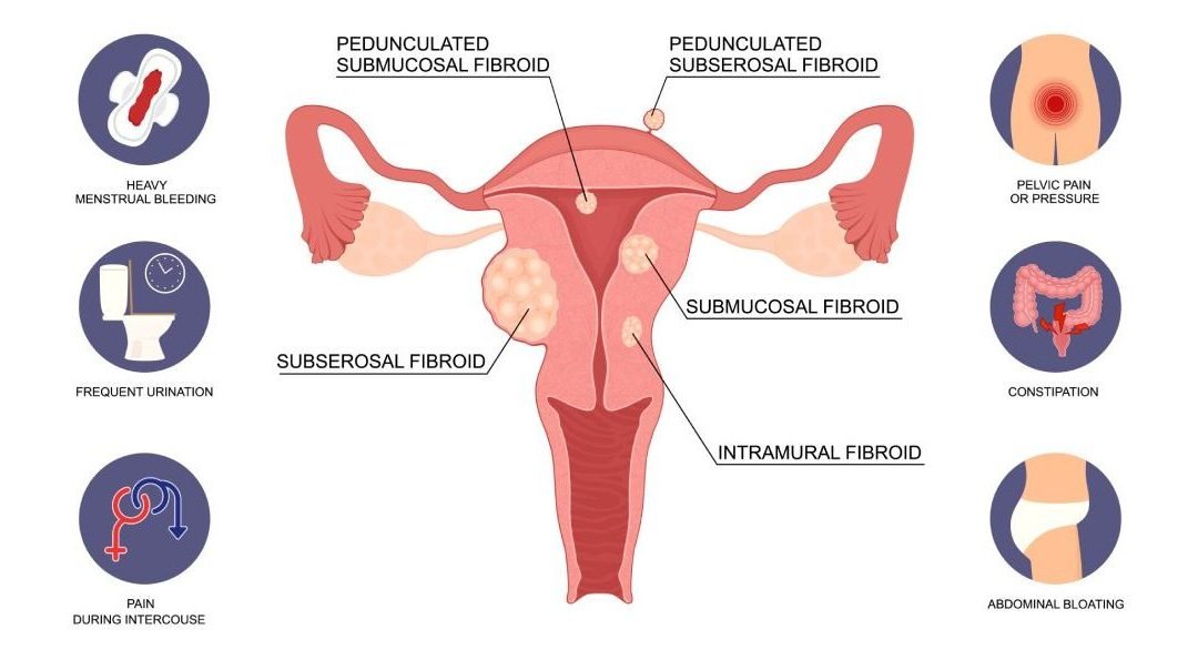 Advances in Non-Surgical Treatments for Uterine Fibroids